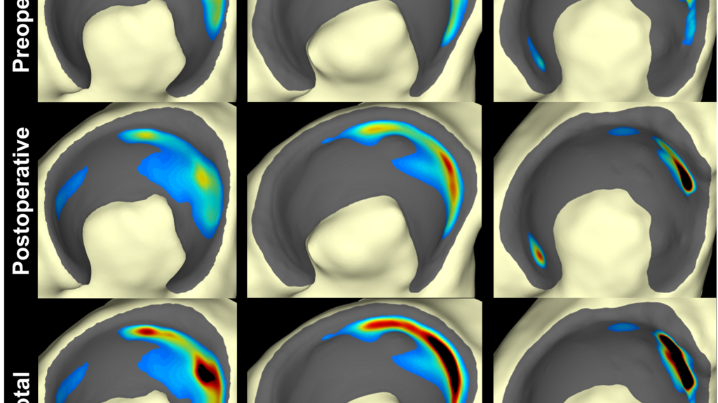A 3x3 grid of rainbow contour plots of contact stress distributed across surface renderings of an acetabulum